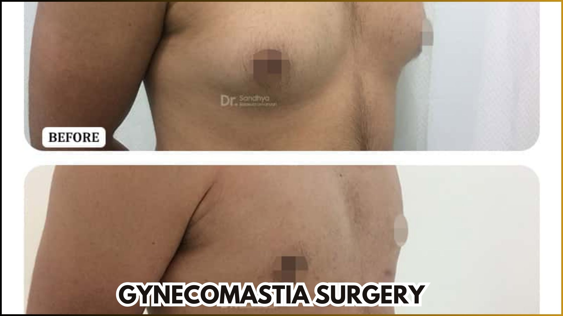 Get Gynecomastia Surgery In Bangalore